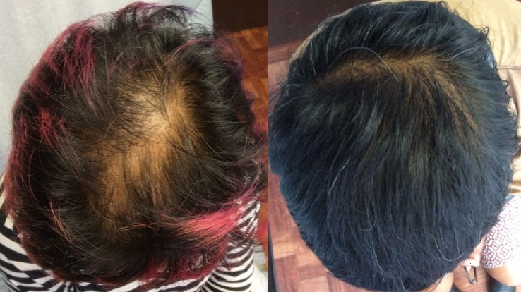 Stem Cell Therapy for Hair Loss