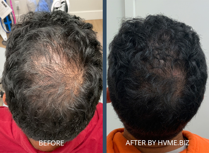 Exosome Therapy for Hair Loss